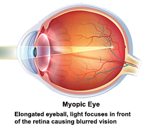 mikor szűnt meg a myopia látás plusz 2 mi ez