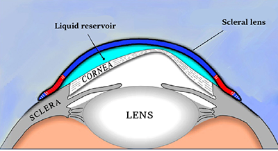 scleral contact lenses keratoconus